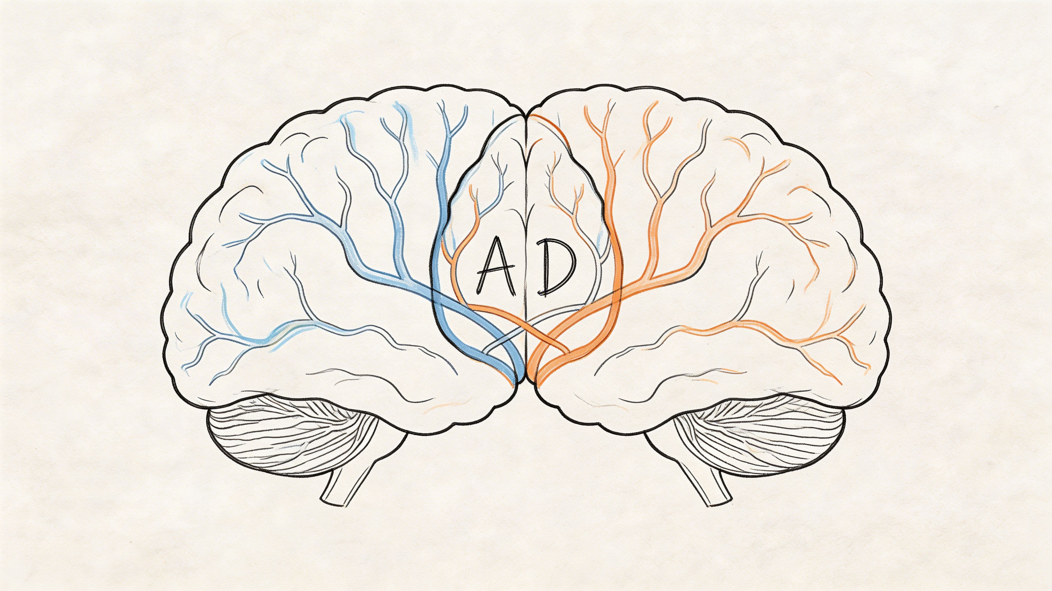 Conceptual split-brain illustration with AD letters showing autism and ADHD overlap and shared genetic risk.